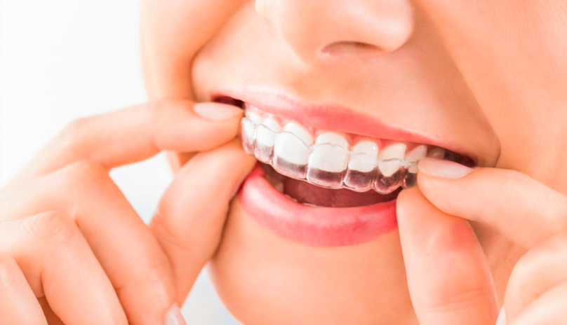 clear aligner pic