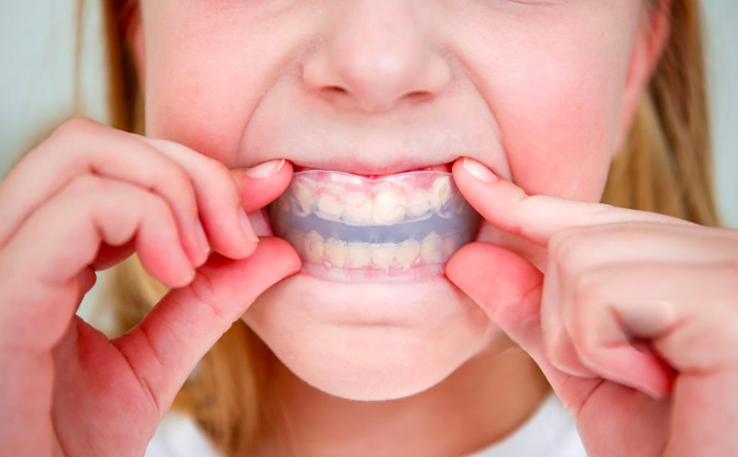 kids braces
